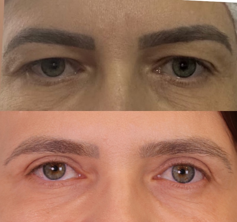 Caso 01 — antes e depois de BLEFAROPLASTIA SUPERIOR