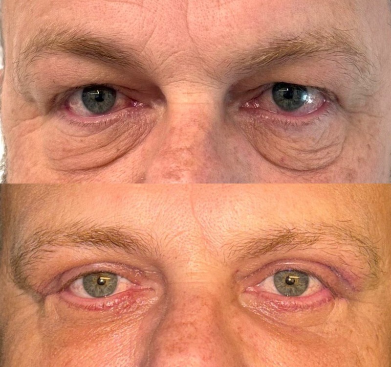 Caso 03 — antes e depois de BLEFAROPLASTIA SUPERIOR + INFERIOR