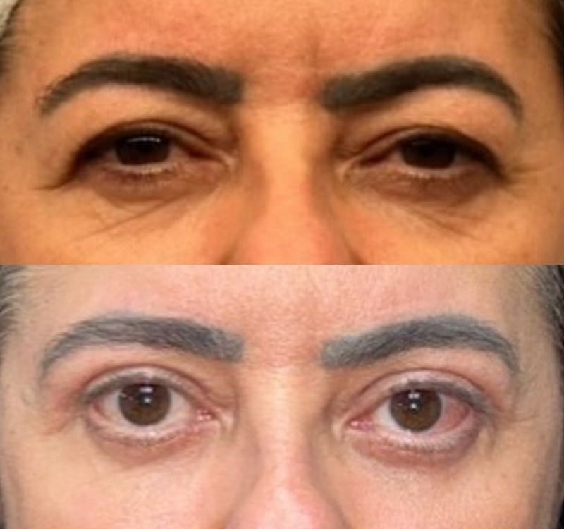 Caso 04 — antes e depois de Blefaroplastia Superior + Inferior