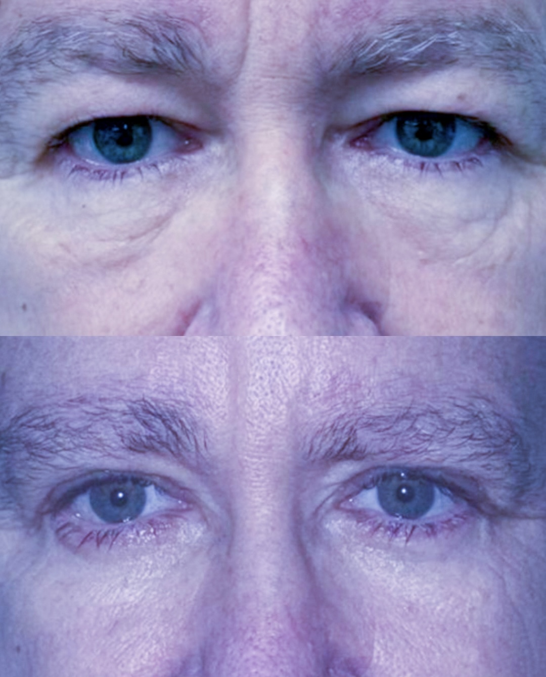 Caso 04 — antes e depois de Blefaroplastia Superior + Inferior